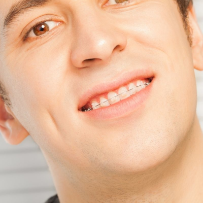 Ceramic Braces